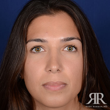 Open Rhinoplasty After Photo