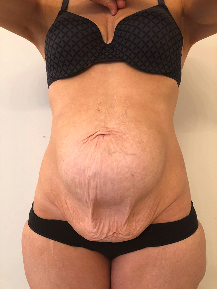Before Photo of Diastasis Recti in Beverly Hills 03
