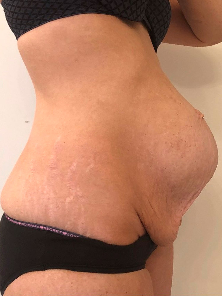 Before Photo of Diastasis Recti in Beverly Hills 04
