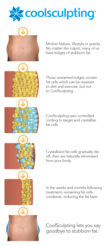 The CoolSculpting process: an infographic