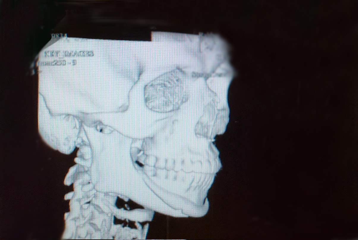 Chin malposition x-ray