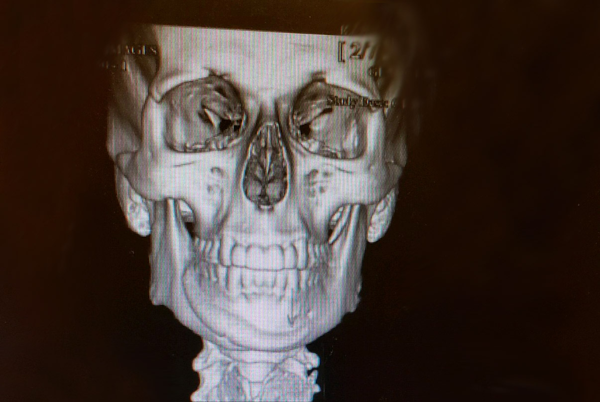 Chin malposition x-ray 02